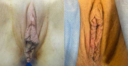 pb-clitoral-hood-reduction-labiaplasty-perineoplasty-before-after-nyc-1