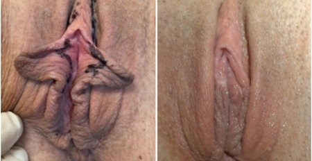 pb-clitoral-hood-reduction-labiaplasty-perineoplasty-before-after-nyc-2