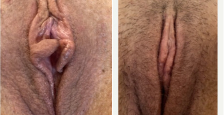 pb-labiaplasty-and-clitoral-hood-reduction-surgery-before-after-nyc-3