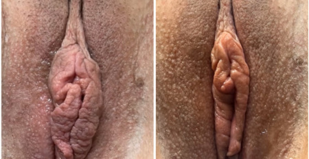 pb-labiaplasty-and-perineoplasty-surgery-before-after-nyc-1