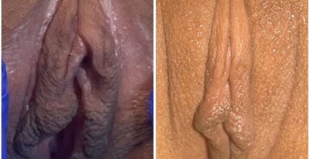 pb-labiaplasty-surgery-before-after-nyc-1