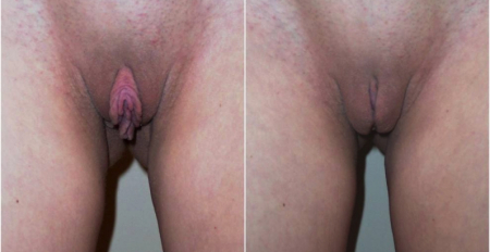 labia-majora1