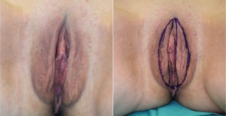 labia-majora2