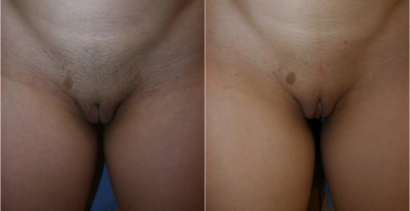 labia-majora4