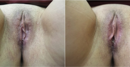 labia-majora5