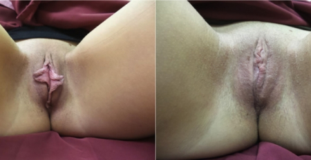 labia-majora6