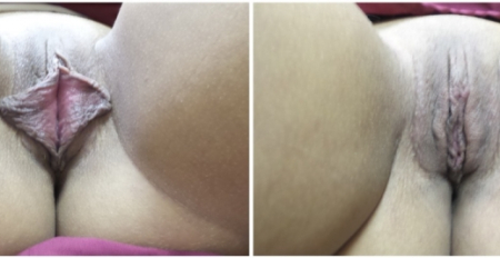 Bilateral-Labia-minora-reduction1-nyc-main