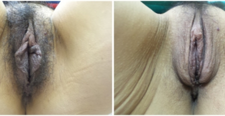 Bilateral-Labia-minora-reduction2-nyc-main