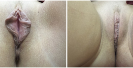 Bilateral-Labiaplasty1-nyc-main