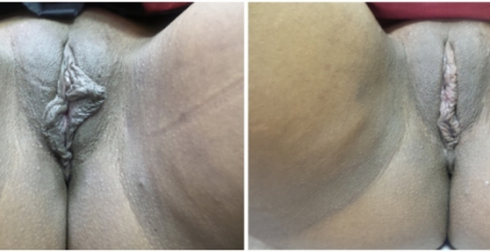 Bilateral-Labiaplasty2-nyc-main