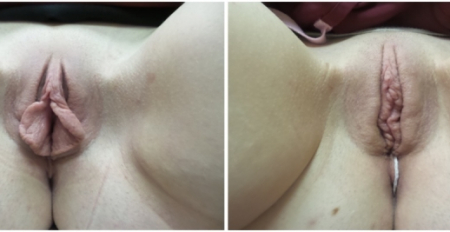 Bilateral-Labiaplasty3-nyc-main
