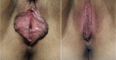 labia-minora-1