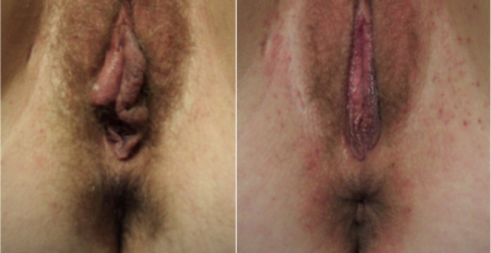 labia-minora-2
