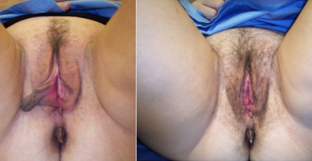 labia-minora-40