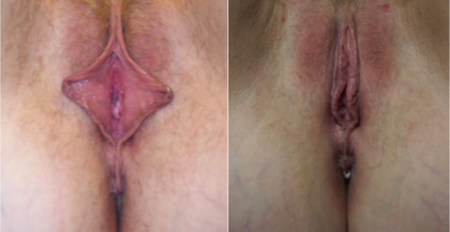 labia-minora-5