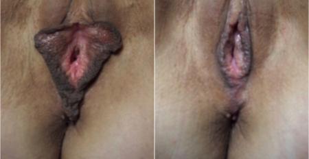 labia-minora-7
