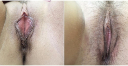 labiaplasty12