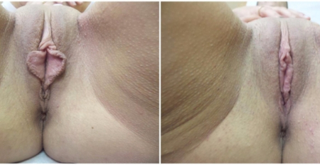labiaplasty13