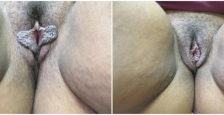 labiaplasty14