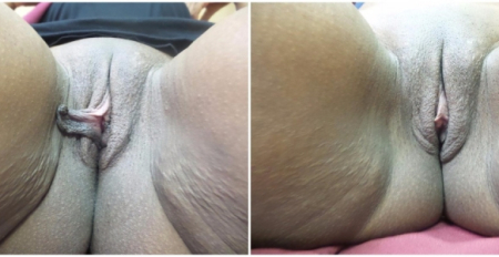 labiaplasty16