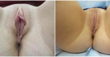 labiaplasty18