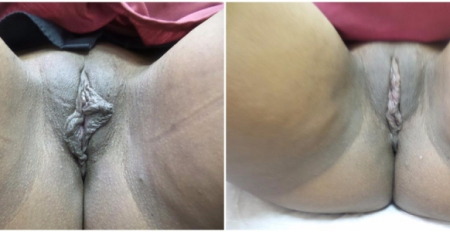 labiaplasty21